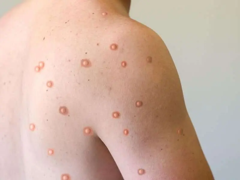 Mpox
